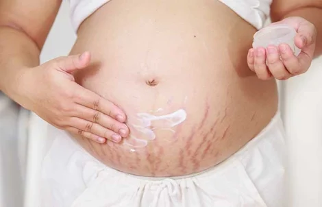 Apakah Stretch Mark Bisa Hilang Total?