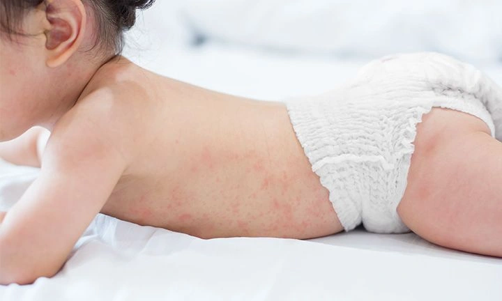 Cara Mengatasi Ruam Popok Bayi Agar Cepat Sembuh dan Nyaman