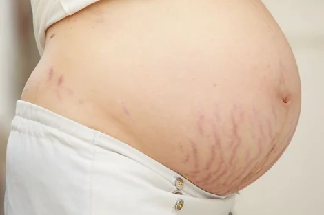 Stretch Mark Bisa Pudar dengan Minyak Zaitun? Ini Faktanya
